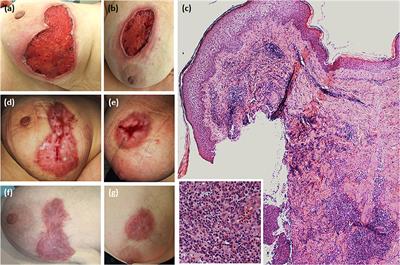 Post-surgical Thyroid Bed Pyoderma Gangrenosum Mimicking Recurrent Papillary Thyroid Carcinoma